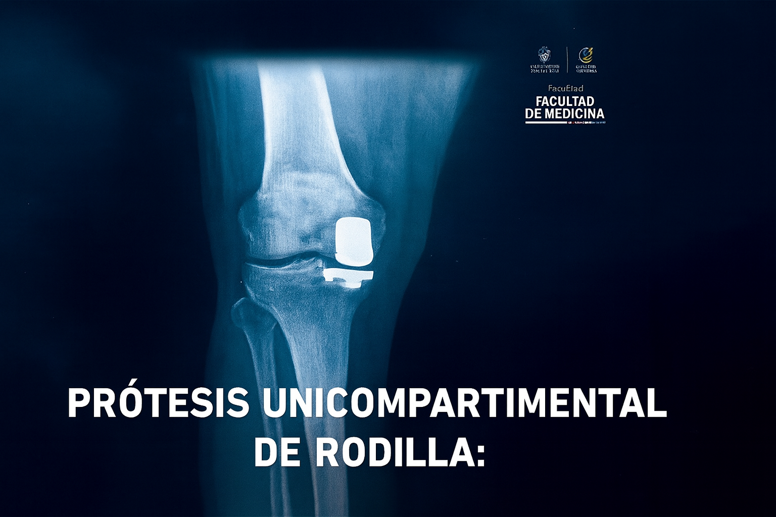 Esta guía técnica sobre prótesis unicompartimental de rodilla ofrece una visión actual, basada en evidencia, para cirujanos ortopédicos y traumatólogos.
